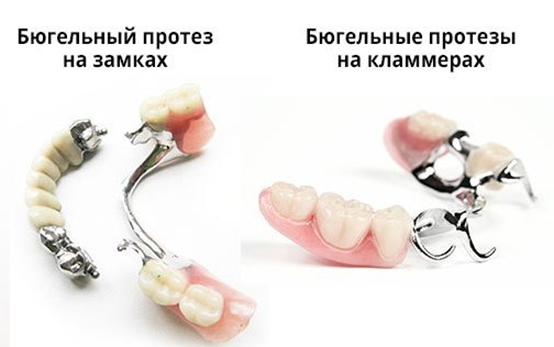 Акриловый протез